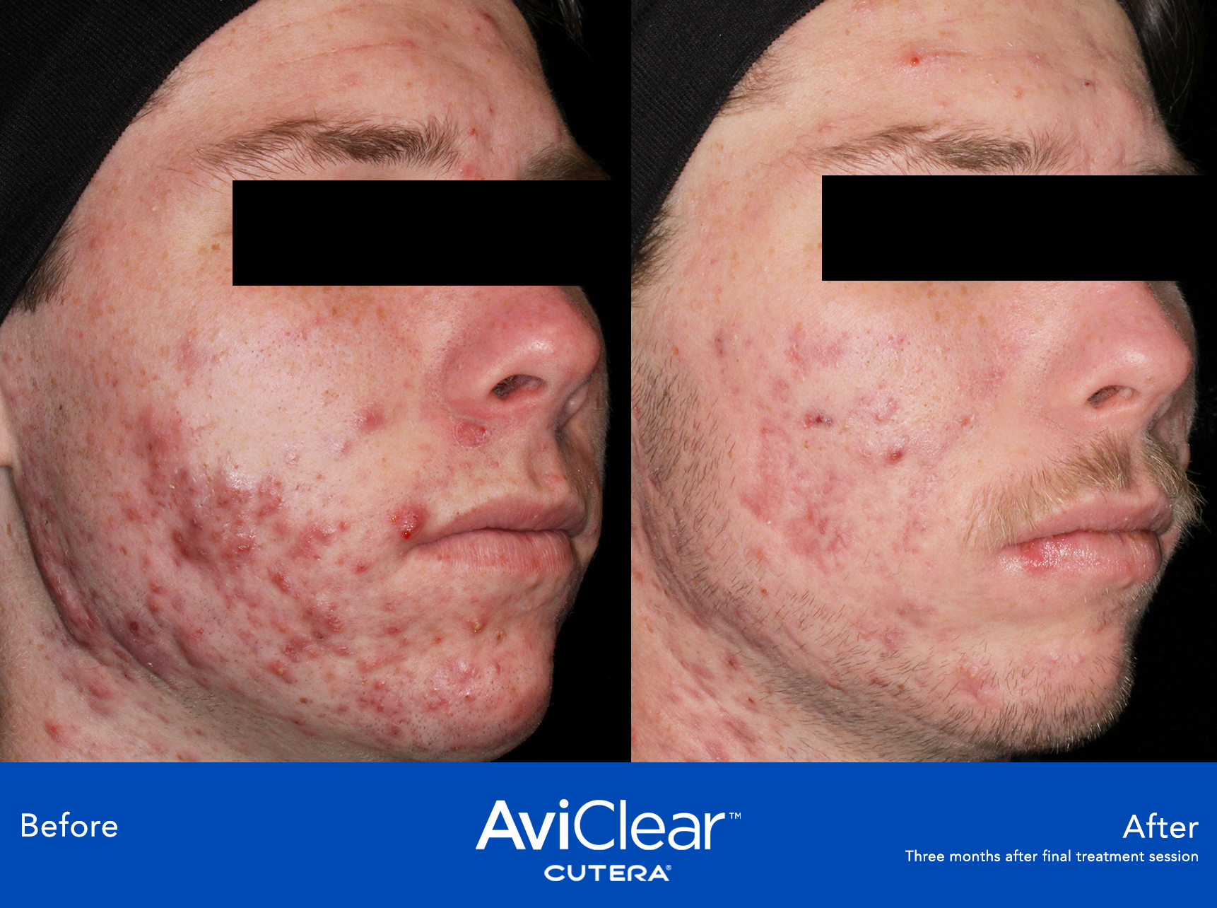 Acne Laser Clinic