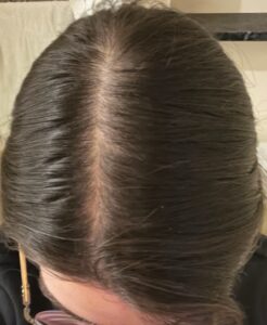 After 2 PRP treatments with no other hair loss treatment.