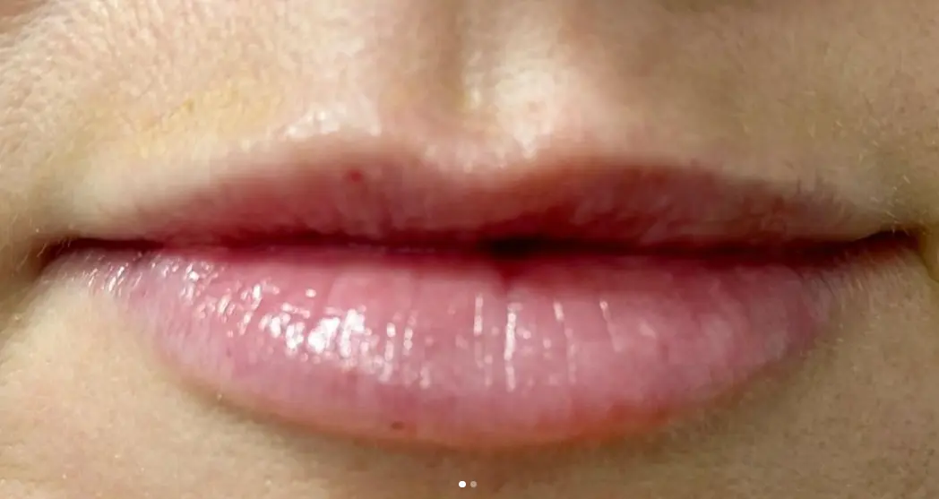 Juvederm Ultra after treatment