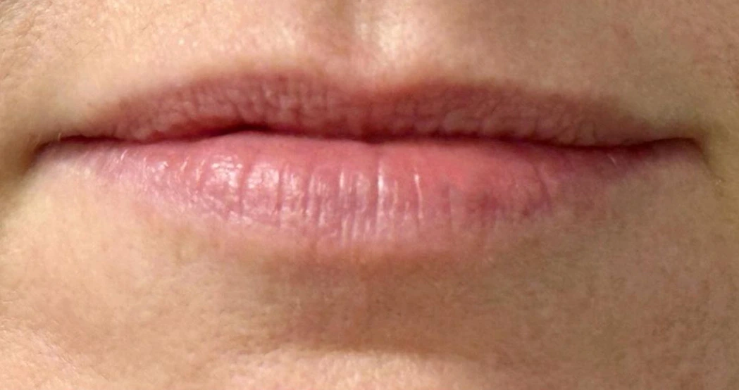 Juvederm Ultra before treatment