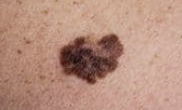 Melanoma