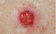 Basal Cell Carcinoma (BCC)
