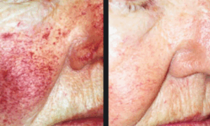 rosacea before and after photo