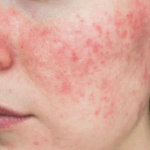 National Rosacea Awareness Month