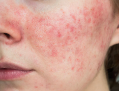 National Rosacea Awareness Month