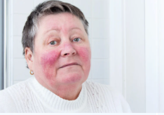 triggered rosacea