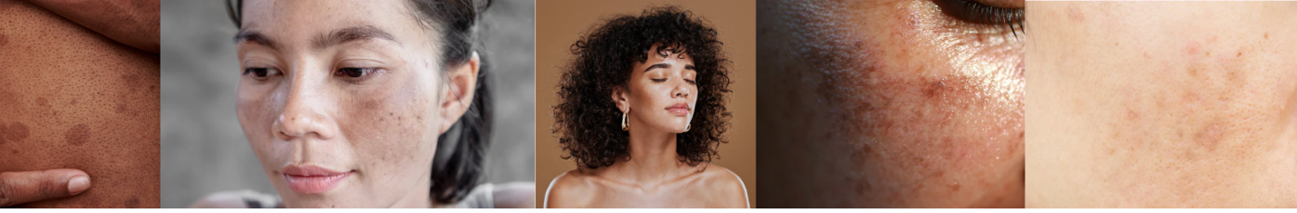 Solution for Hyperpigmentation
