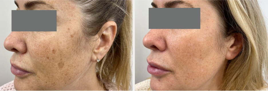 PicoWay Laser before and after photo
